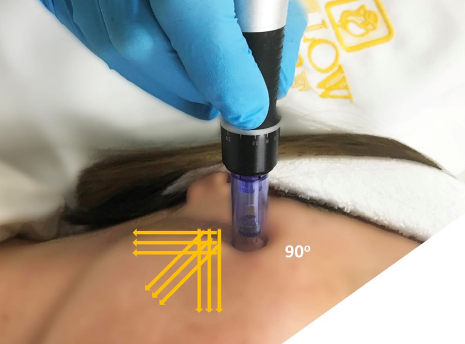 Yellow Rose Microneedling ansiktsbehandling hemma med dermoroller