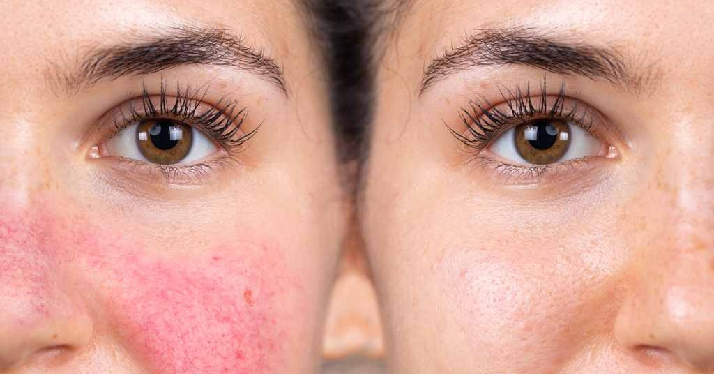 Hudvårdsrutin för känslig hud – steg för steg guide