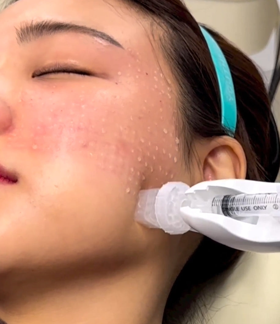 Kurs i Biorevitalisering + RF microneedling - DermaShine